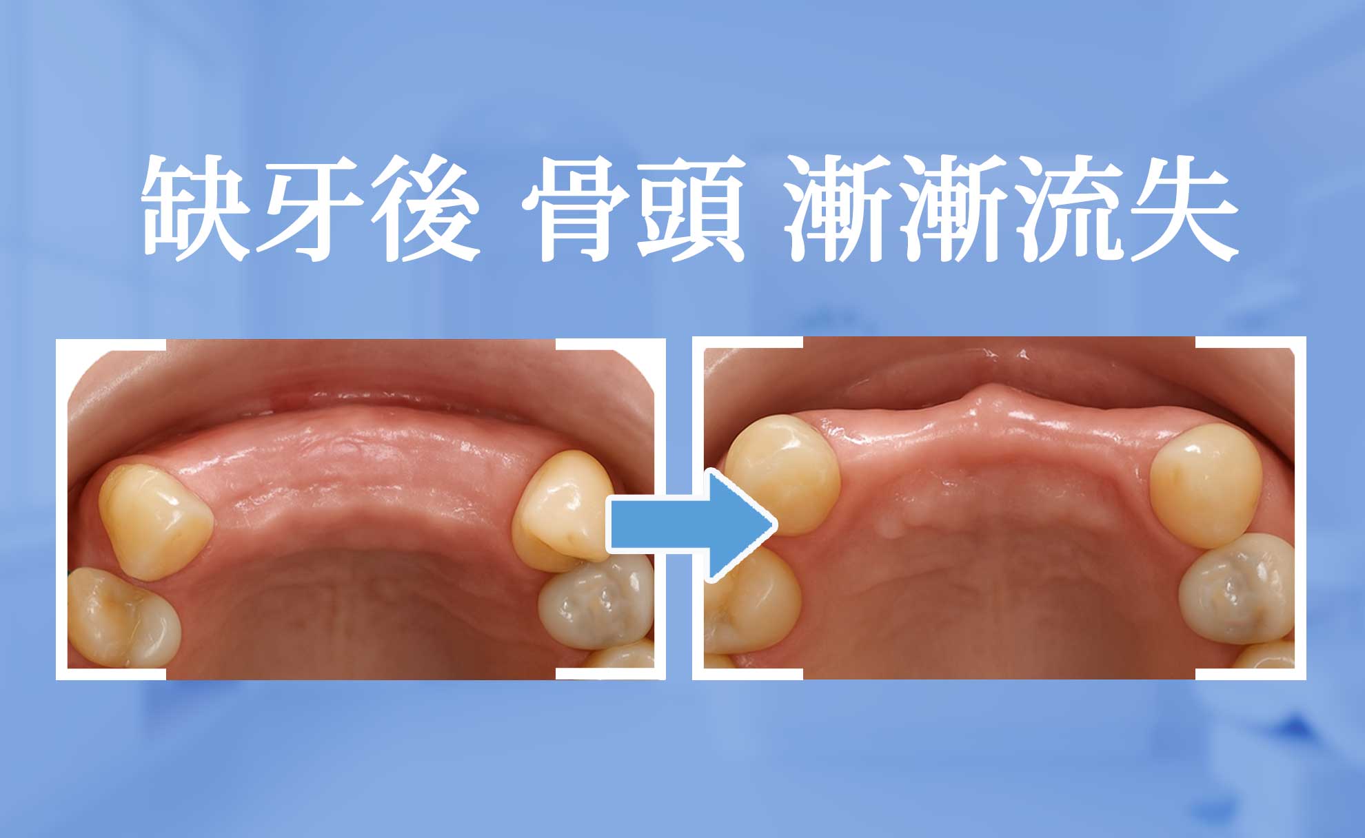 All-on-4 全口重建植牙示意圖，展示植體如何支撐整排假牙