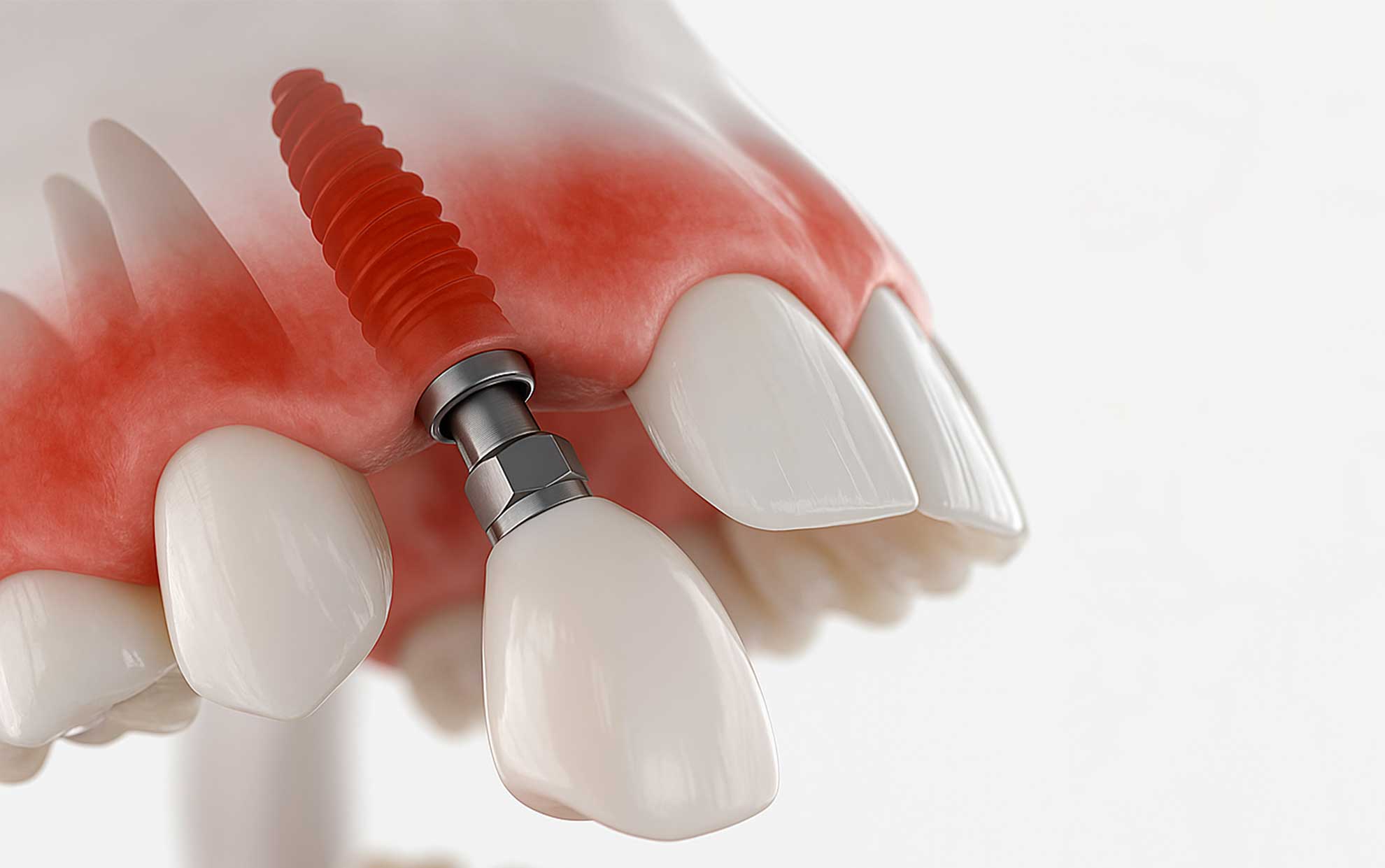 一名患者指著自己健康的植牙，展現自信笑容