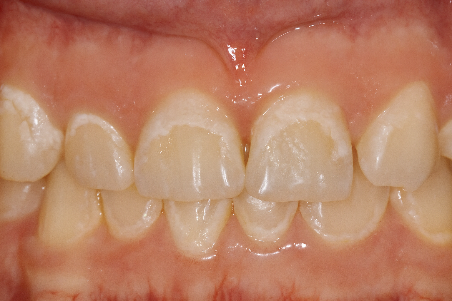 牙齒脫鈣怎麼辦？改善方法與預防重點一次看懂